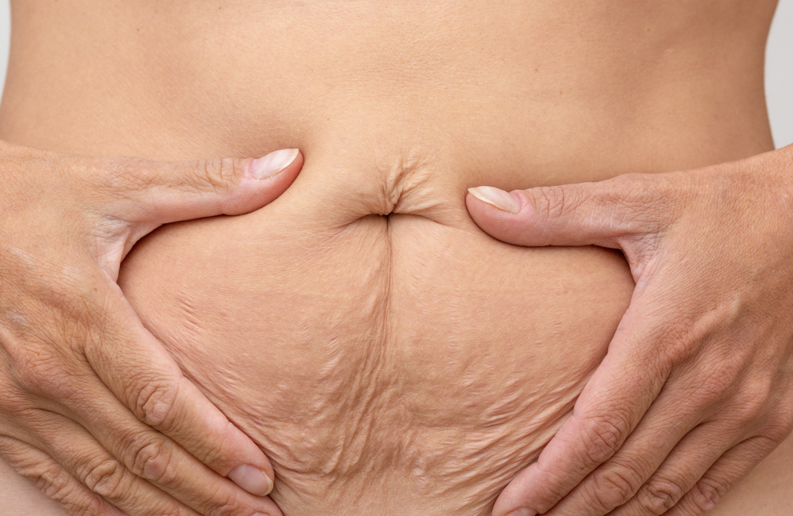 crepey skin on belly post partum